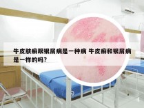 牛皮肤癣跟银屑病是一种病 牛皮癣和银屑病是一样的吗?