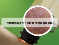 生物制剂能管什么皮肤病 生物制剂皮肤科