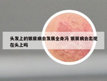 头发上的银屑病会发展全身冯 银屑病会出现在头上吗