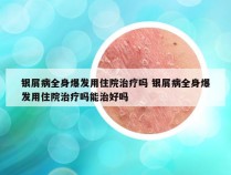 银屑病全身爆发用住院治疗吗 银屑病全身爆发用住院治疗吗能治好吗