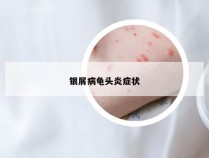 银屑病龟头炎症状