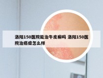 洛阳150医院能治牛皮癣吗 洛阳150医院治癌症怎么样