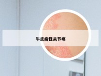 牛皮癣性关节痛