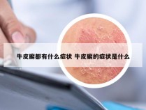 牛皮廨都有什么症状 牛皮廨的症状是什么