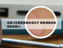 皮肤ct诊断银屑病会误诊不 银屑病做皮肤镜和皮肤ct