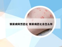 银屑病突然恶化 银屑病恶化会怎么样