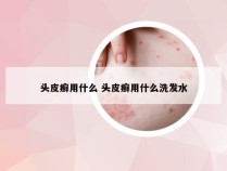 头皮癣用什么 头皮癣用什么洗发水