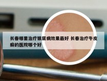 长春哪里治疗银屑病效果最好 长春治疗牛皮癣的医院哪个好