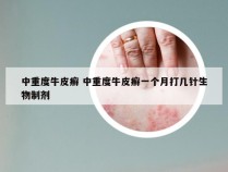 中重度牛皮癣 中重度牛皮癣一个月打几针生物制剂