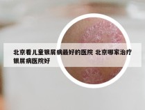 北京看儿童银屑病最好的医院 北京哪家治疗银屑病医院好