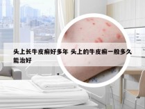 头上长牛皮癣好多年 头上的牛皮癣一般多久能治好