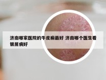 济南哪家医院的牛皮癣最好 济南哪个医生看银屑病好