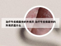 治疗牛皮癣最快的外用药 治疗牛皮癣最快的外用药是什么