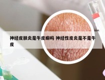 神经皮肤炎是牛皮癣吗 神经性皮炎是不是牛皮