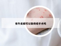 有牛皮癣可以做痔疮手术吗