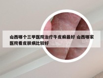 山西哪个三甲医院治疗牛皮癣最好 山西哪家医院看皮肤病比较好
