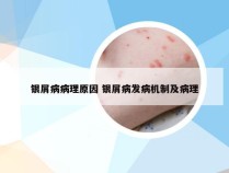 银屑病病理原因 银屑病发病机制及病理