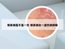 银屑病是不是一热 银屑病会一遇热就痒嘛