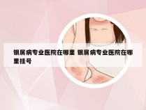银屑病专业医院在哪里 银屑病专业医院在哪里挂号