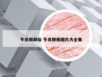 牛皮癣脚趾 牛皮脚癣图片大全集