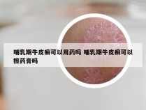 哺乳期牛皮癣可以用药吗 哺乳期牛皮癣可以擦药膏吗