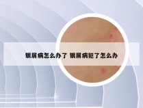 银屑病怎么办了 银屑病犯了怎么办