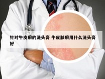 针对牛皮癣的洗头膏 牛皮肤癣用什么洗头膏好