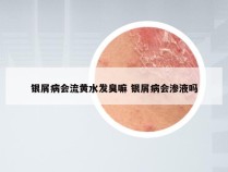 银屑病会流黄水发臭嘛 银屑病会渗液吗