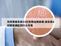 为何用维生素D3衍生物治银屑病 维生素d对银屑病起到什么作用