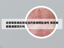 皮肤银屑病皮损处涂药做病理能准吗 银屑病需要病理切片吗