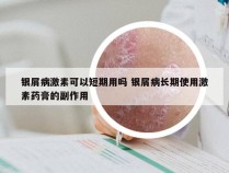 银屑病激素可以短期用吗 银屑病长期使用激素药膏的副作用