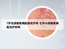 7岁女孩银屑病能做光疗吗 七岁小孩银屑病能治疗好吗