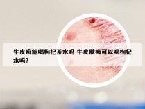 牛皮癣能喝枸杞茶水吗 牛皮肤癣可以喝枸杞水吗?