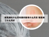 银屑病吃什么药效果好都用什么药膏 银屑病抺什么药好