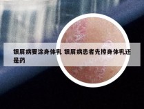 银屑病要涂身体乳 银屑病患者先擦身体乳还是药