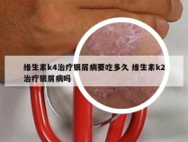 维生素k4治疗银屑病要吃多久 维生素k2治疗银屑病吗