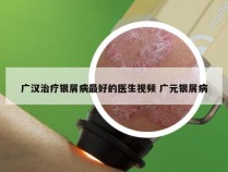 广汉治疗银屑病最好的医生视频 广元银屑病