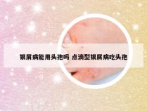 银屑病能用头孢吗 点滴型银屑病吃头孢