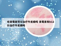 吃青霉素可以治疗牛皮癣吗 青霉素和b12针治疗牛皮癣吗