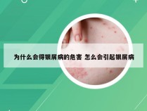 为什么会得银屑病的危害 怎么会引起银屑病