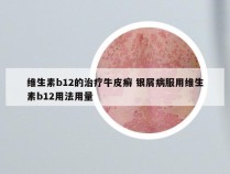 维生素b12的治疗牛皮癣 银屑病服用维生素b12用法用量