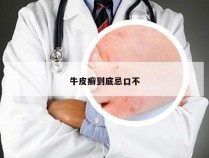牛皮癣到底忌口不