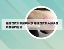 脂溢性皮炎银屑病头部 脂溢性皮炎头藓头皮银屑病的鉴别