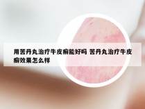 用苦丹丸治疗牛皮癣能好吗 苦丹丸治疗牛皮癣效果怎么样