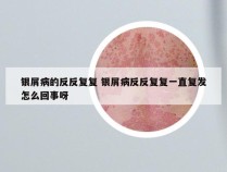银屑病的反反复复 银屑病反反复复一直复发怎么回事呀