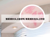 银屑病长头上能好吗 银屑病长在头上妙招