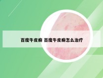 百度牛皮癣 百度牛皮癣怎么治疗