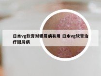 日本vg软膏对银屑病有用 日本vg软膏治疗银屑病