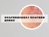 安庆治疗银屑病价格是多少 安庆治疗银屑病医院哪家好