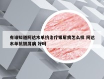 有谁知道阿达木单抗治疗银屑病怎么样 阿达木单抗银屑病 好吗